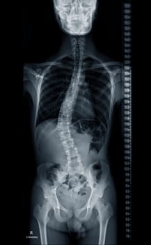 X-ray image of Whole Spine for diagnosis scoliosis of spine.