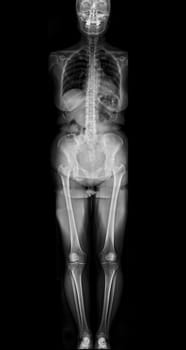 X-ray image of Human Skeletal or whole body.