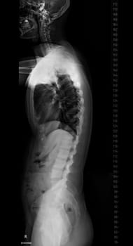 X-ray image of Whole Spine for diagnosis scoliosis of spine.