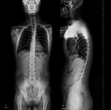 X-ray image of Whole Spine for diagnosis scoliosis of spine.