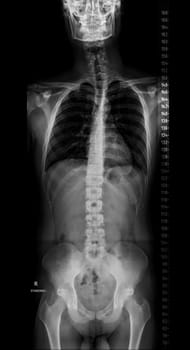 X-ray image of Whole Spine for diagnosis scoliosis of spine.