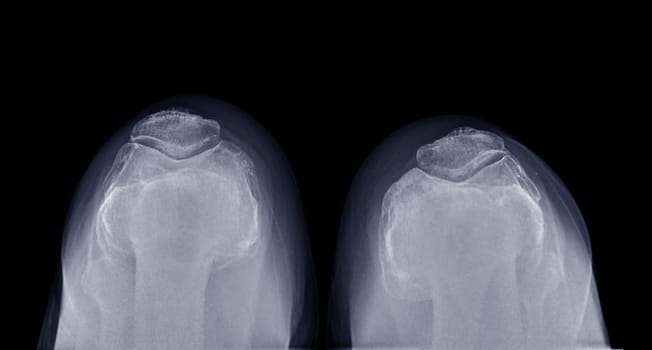 X-ray image of both patella fracture for diagnostic patella fracture or patella dislocation.