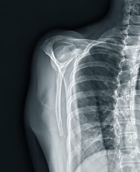 X-ray Shoulder joint shoulder transcapular view for diagnosis fracture of shoulder joint.
