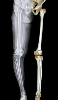 Scanogram is a Full-length standing AP radiograph of both lower extremities and 3D rendering including the hip, knee, and ankle.