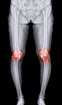 Scanogram is a Full-length standing AP radiograph of both lower extremities including the hip, knee, and ankle.