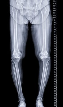 Scanogram is a Full-length standing AP radiograph of both lower extremities including the hip, knee, and ankle.