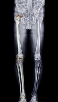 Scanogram is a Full-length standing AP radiograph of both lower extremities including the hip, knee, and ankle with 3D rendering.