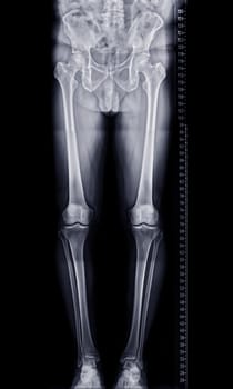 Scanogram is a Full-length standing AP radiograph of both lower extremities including the hip, knee, and ankle.