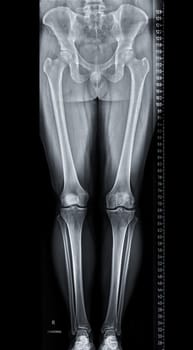 Scanogram is a Full-length standing AP radiograph of both lower extremities including the hip, knee, and ankle.