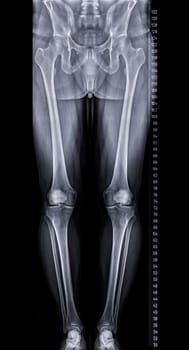 Scanogram is a Full-length standing AP radiograph of both lower extremities including the hip, knee, and ankle.