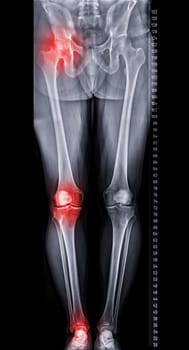 Scanogram is a Full-length standing AP radiograph of both lower extremities including the hip, knee, and ankle.