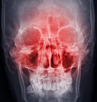 x-ray image of paranasal sinuses for diagnosis sinusitis.