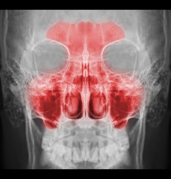 x-ray image of paranasal sinuses for diagnosis sinusitis.
