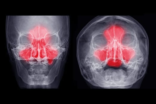 x-ray image of paranasal sinuses Ap and water's view for diagnosis sinusitis.