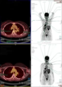 Positron emission tomography (PET) CT scan uses a radioactive drug (tracer) to show both normal and abnormal metabolic activity of Whole human body for detect cancer recurrence after surgery .