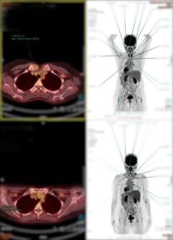 Positron emission tomography (PET) CT scan uses a radioactive drug (tracer) to show both normal and abnormal metabolic activity of Whole human body for detect cancer recurrence after surgery .