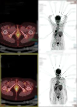 Positron emission tomography (PET) CT scan uses a radioactive drug (tracer) to show both normal and abnormal metabolic activity of Whole human body for detect cancer recurrence after surgery .