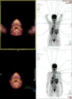 Positron emission tomography (PET) CT scan uses a radioactive drug (tracer) to show both normal and abnormal metabolic activity of Whole human body for detect cancer recurrence after surgery .