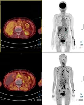 Positron emission tomography (PET) CT scan uses a radioactive drug (tracer) to show both normal and abnormal metabolic activity of Whole human body for detect cancer recurrence after surgery .