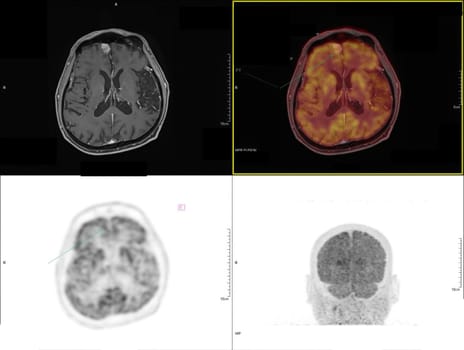 Positron emission tomography (PET) CT scan uses a radioactive drug (tracer) to show both normal and abnormal metabolic activity of Whole human body for detect cancer recurrence after surgery .