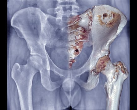 Xray Pelvic Bone ap view with fusion 3D rendering .