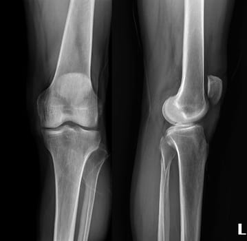 film x-ray both knee joint AP view for diagnosis knee pain from osteoarthritis knee and fracture .