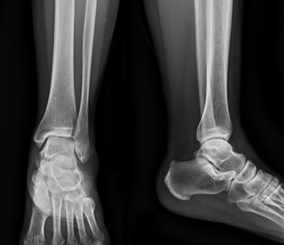 X-ray image of ankle joint .