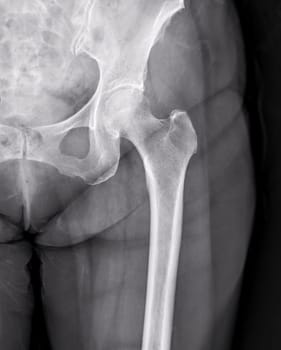 X-ray of Left hip joint front view.