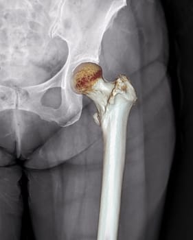 X-ray of Left hip joint front view with 3d rendering of left femur .