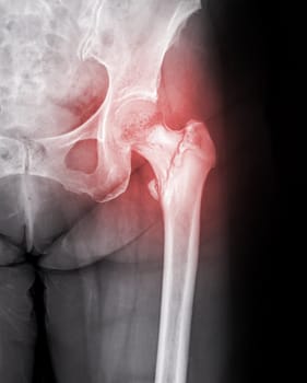 X-ray of Left hip joint front view.