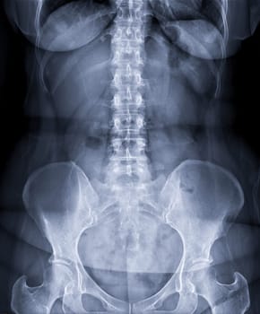 X-ray image of lumbar Spine or L-s spine front view for diagnosis lower back pain.