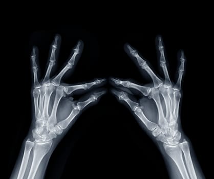 Film x-ray both hand oblique view show human's hands isolated on black background .