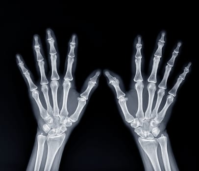 Film x-ray both hand AP view show human's hands isolated on black background .