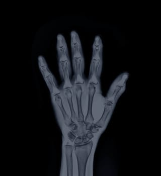 Film x-ray Left Hand AP view show human's hands isolated on black background .