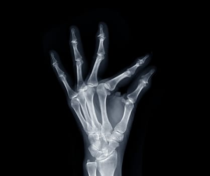 Film x-ray both hand AP view show human's hands isolated on black background .