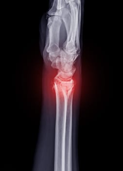 Film x-ray Wrist joint showing fracture of ulnar bone isolated on black background .