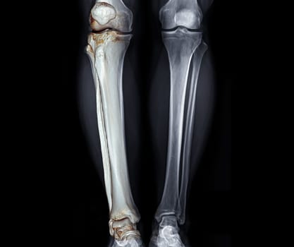 X-ray image of both Leg AP view with 3D leg for diagnostic knee fracrure.