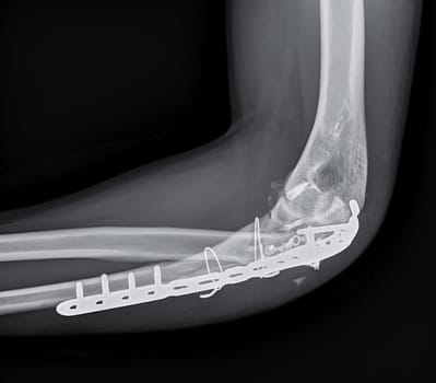 X-ray of Elbow showing internal fixation of the elbow joint.