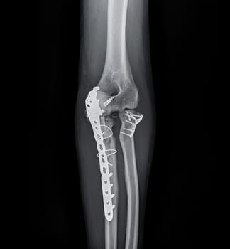 X-ray of Elbow showing internal fixation of the elbow joint.