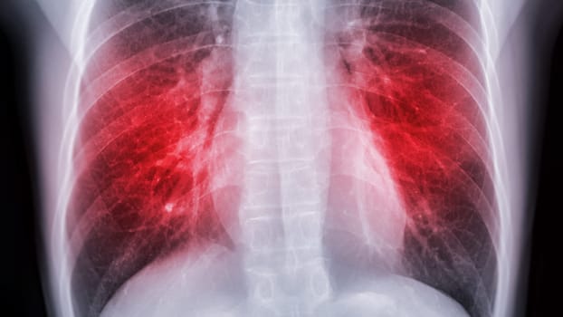 Chest x-ray image for screening diagnosis TB,tuberculosis and covid-19.