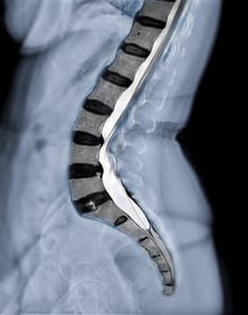 X-ray image of lumbar Spine or L-s spine lateral view with MRI l-s spine for diagnosis lower back pain.