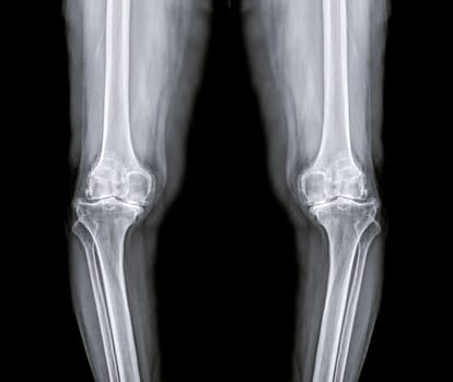 film x-ray both knee joint AP view for diagnosis knee pain from osteoarthritis knee and fracture .