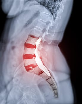 X-ray image of lumbar Spine or L-s spine lateral view with MRI l-s spine for diagnosis lower back pain.