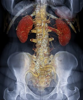 CTA ABDOMINAL AORTA 3D rendering fusion with X-ray Abdomen image.