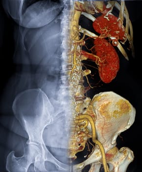 CTA ABDOMINAL AORTA 3D rendering fusion with X-ray Abdomen image.