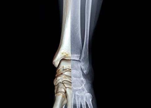 X-ray of knee joint fusion with 3D rendering .