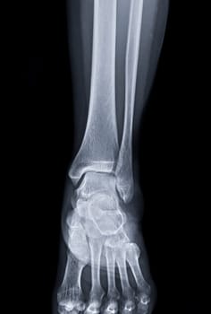 X-ray of knee joint AP view for diagnosis knee pain from osteoarthritis knee and fracture .