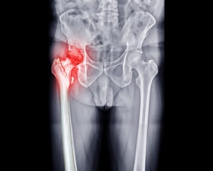 x-ray Both hip ap view showing Right hip replacement or hip prosthesis made from titanium .