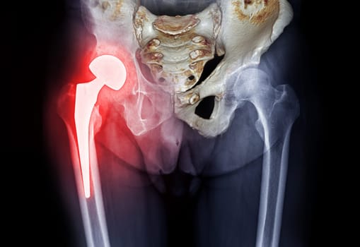 x-ray Both hip ap view showing Right hip replacement or hip prosthesis made from titanium with fusion 3D rendering .