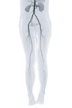 CTA femoral artery run off showing femoral artery Presenting with Acute or Chronic Peripheral Arterial Disease.